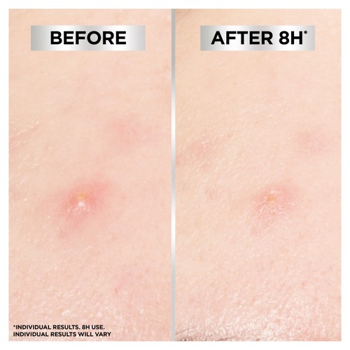 Garnier Pure Active Blemish Patch  thumbnail 2