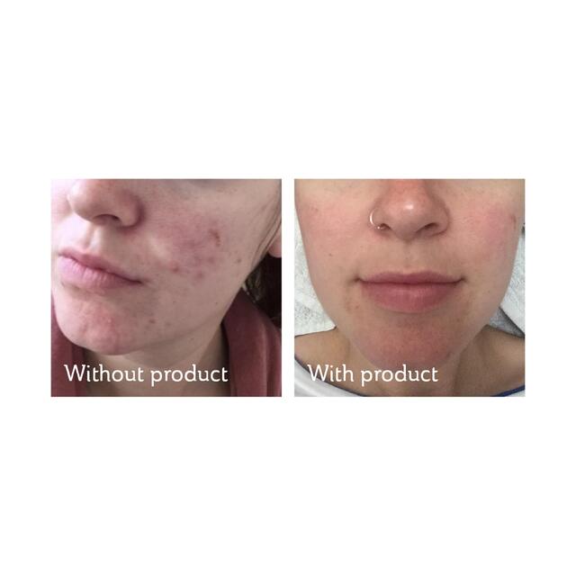 Science of Skin Rescue Acne Scarring thumbnail 3