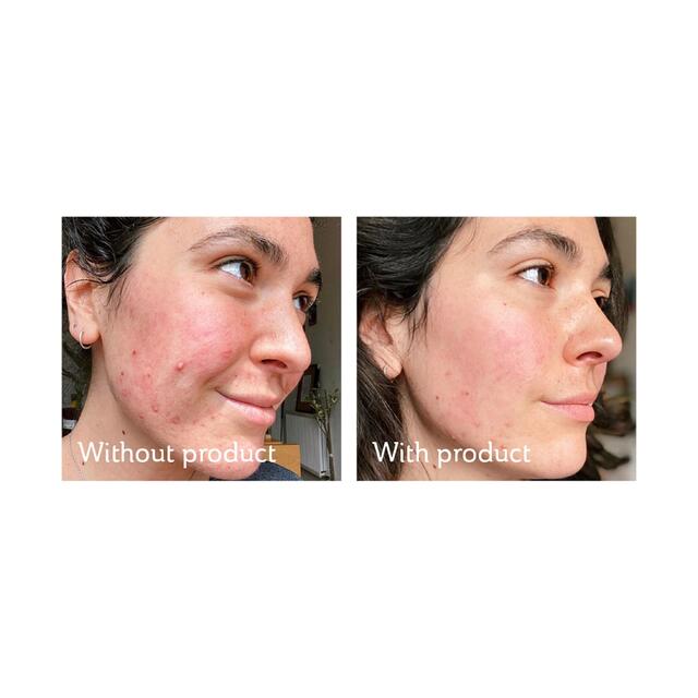 Science of Skin Rescue Acne Scarring thumbnail 4