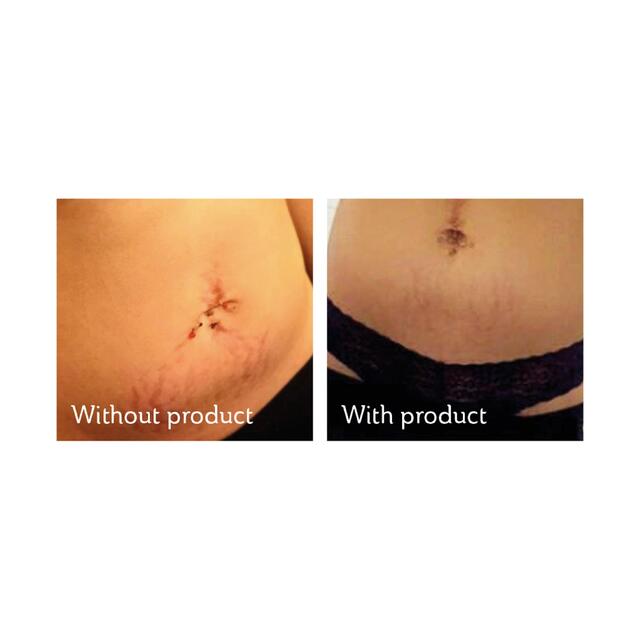 Science of Skin Solution for Stretch Marks thumbnail 3