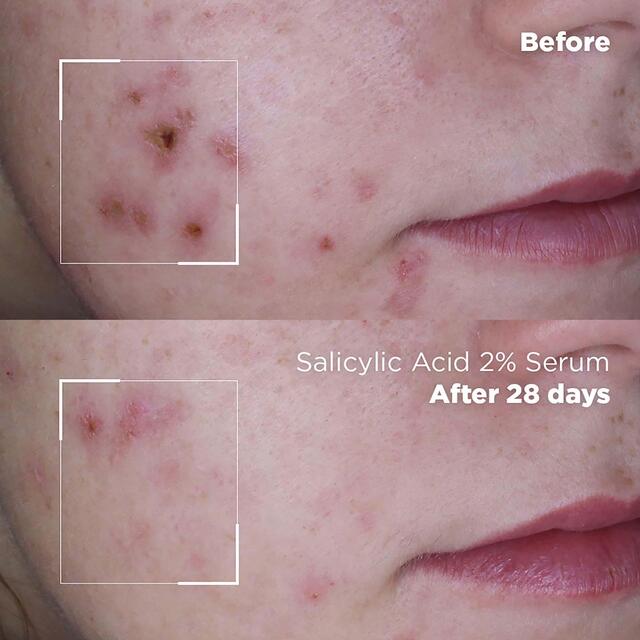 Skin Republic Salicylic Acid 2% Serum thumbnail 4