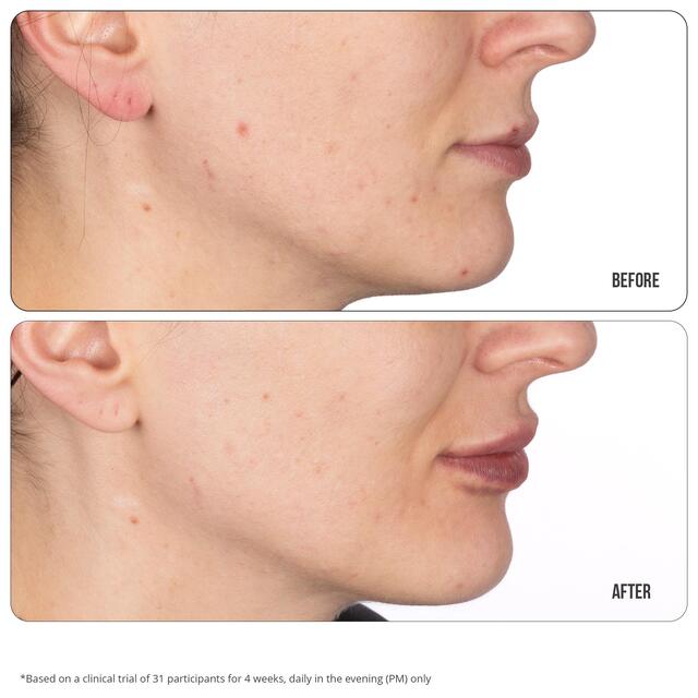 Nip+Fab Retinol Fix Blemish Treatment Gel 10% thumbnail 3