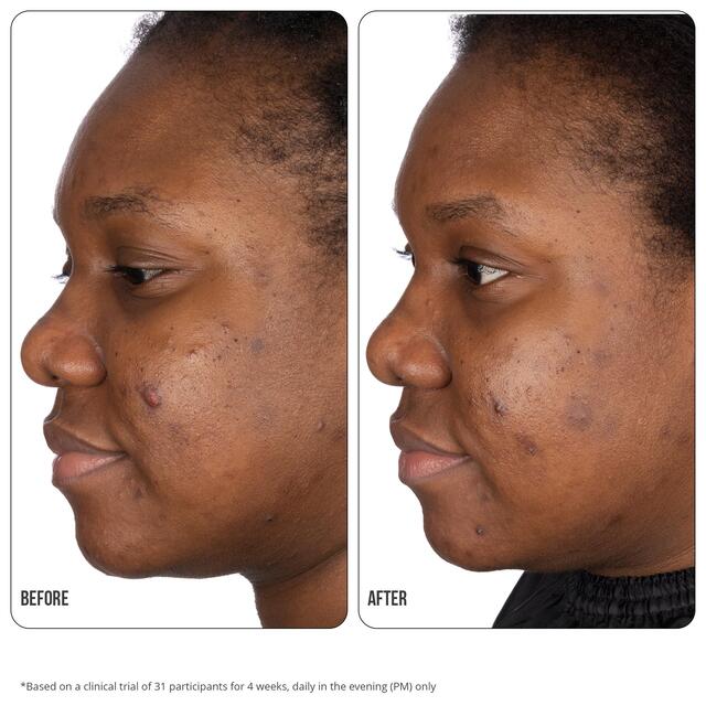 Nip+Fab Retinol Fix Blemish Treatment Gel 10% thumbnail 4