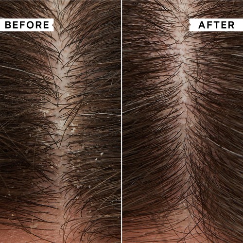 Philip Kingsley Flaky Itchy Scalp Anti-Dandruff Shampoo thumbnail 2