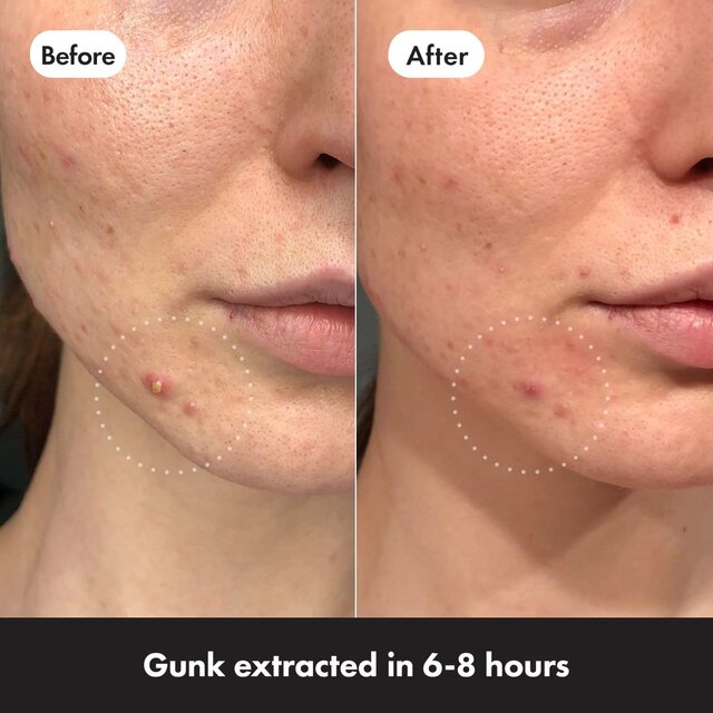 Hero Mighty Pimple Patches Invisible 24 thumbnail 4