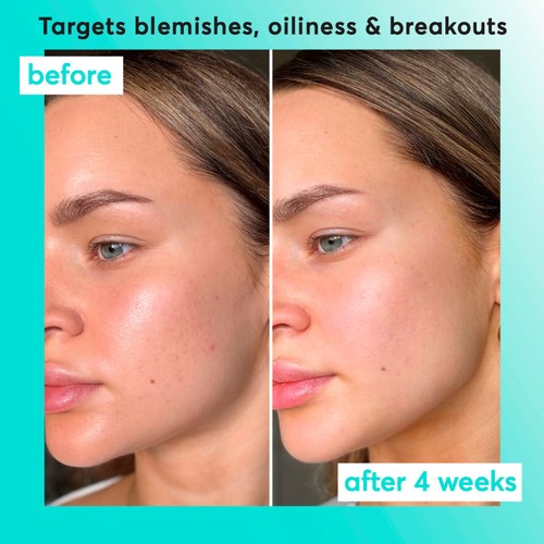 Super Facialist Clear Skin Breakout Buster Serum thumbnail 4