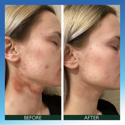 Sorted Skin Intensive Rescue Spray- Prebiotic Microbiome based thumbnail 5