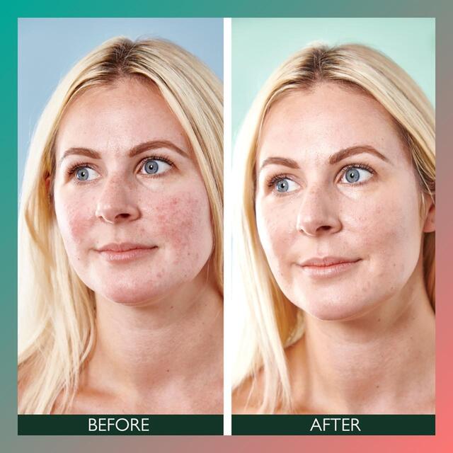 Sorted Skin 5 in 1 Anti-Redness SPF50 Day Cream - Prebiotic Microbiome thumbnail 3