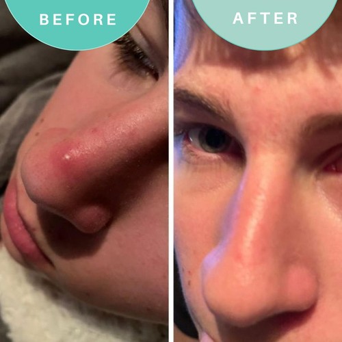 Skin Genius Hits The Spot Spot Zapper thumbnail 3