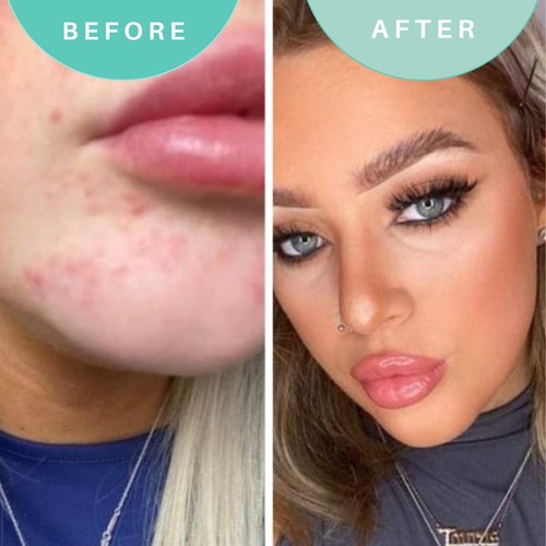 Skin Genius Hits The Spot Spot Zapper thumbnail 4