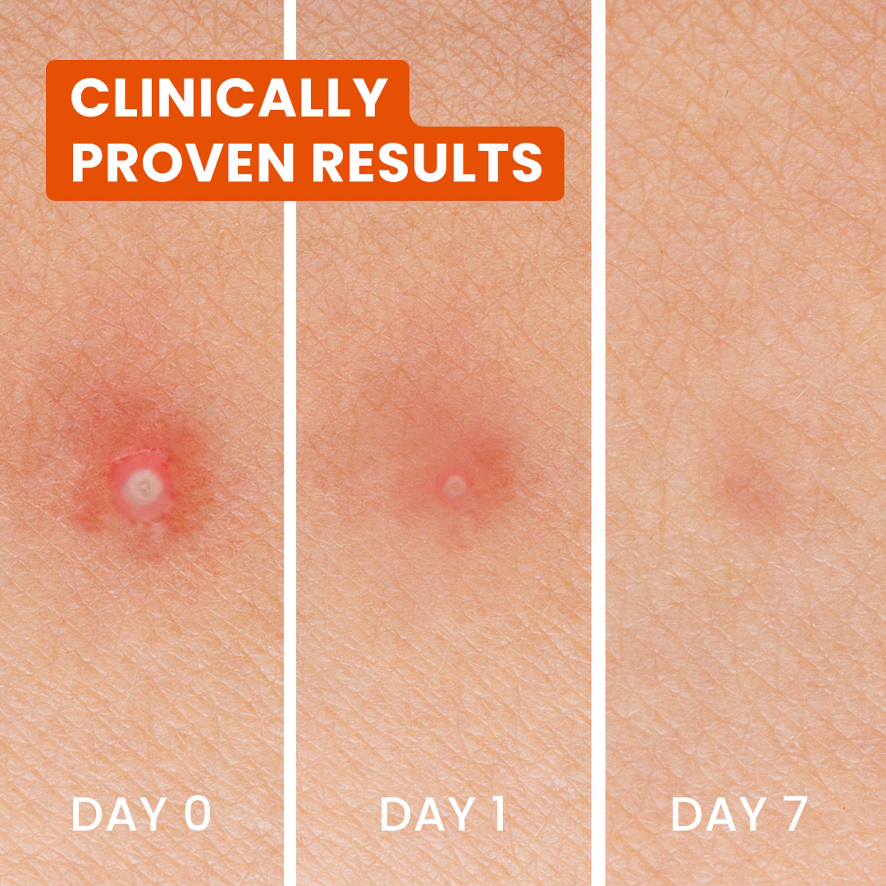 Biore Spot Control 3in1 Spot Patches x24 thumbnail 5