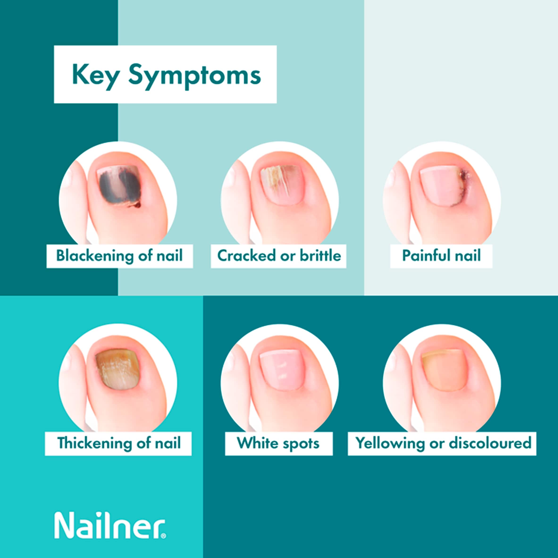 Nailner 2 in 1 Brush Antifungal Nail Treatment 5ml for Fungal Nails thumbnail 3