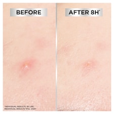 Garnier Pure Active Blemish Patch 22 Pack thumbnail 5