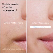 Braun Smart IPL Skin i·expert, At Home Hair Removal, Pouch, Venus Razor, 2 Heads, PL7147 thumbnail 5