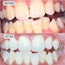 Smile Science Harley Street Teeth Whitening Treatment Kit thumbnail 4